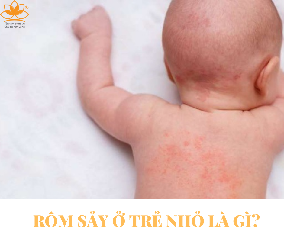 RÔM SẢY MÙA HÈ (Miliaria)